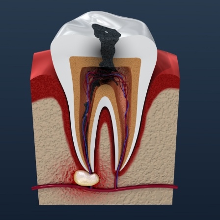 Illustrated damaged tooth