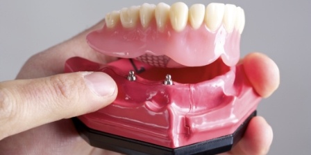 Hand holding a model of an implant denture