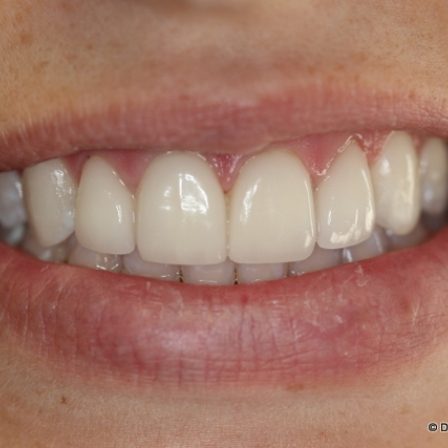 Close up of smile with brighter teeth