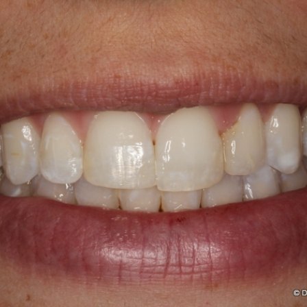 Close up of smile with slightly discolored teeth