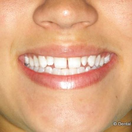 Smile with misaligned teeth