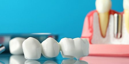 Dental bridge on reflective surface in front of model dental implant