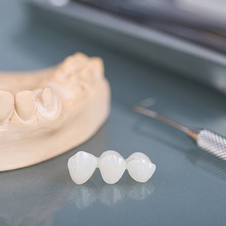 Dental bridge components on a table 