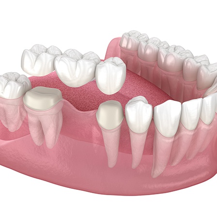 An illustration of a traditional dental bridge anchored to natural teeth 