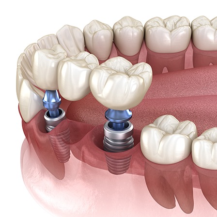 An illustration of an implant-supported dental bridge in the jawbone 