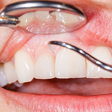 Close up of dental cleaning