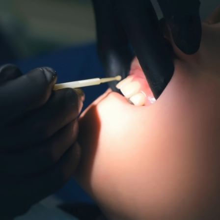 Child getting silver diamine fluoride placed on their teeth by dentist