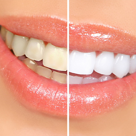 Close up of smile before and after teeth whitening