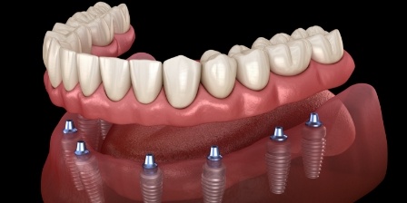Illustrated denture being placed onto eight dental implants