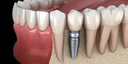 Illustrated dental implant with dental crown