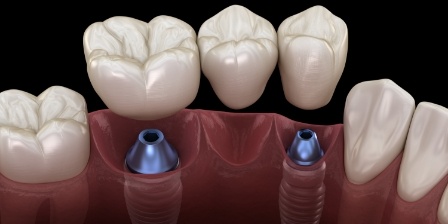 Illustrated dental bridge being placed onto two dental implants