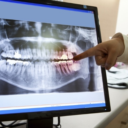 Dentist pointing to an X ray of teeth on computer screen
