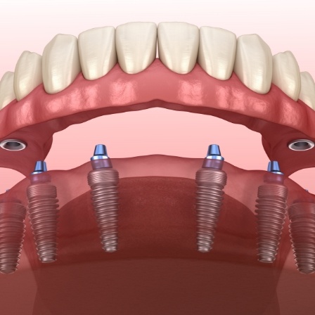 Illustrated denture being placed onto several dental implants throughout the jaw