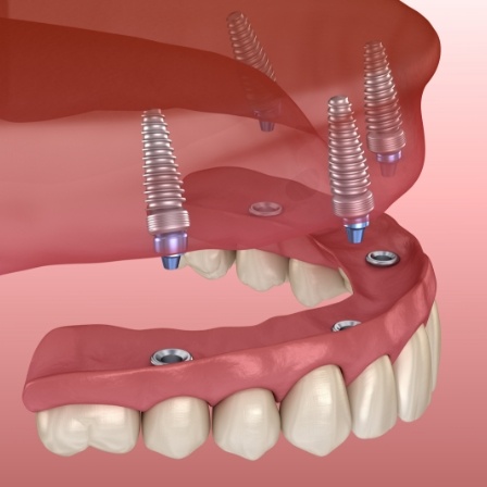 Illustrated implant denture being placed in the upper arch