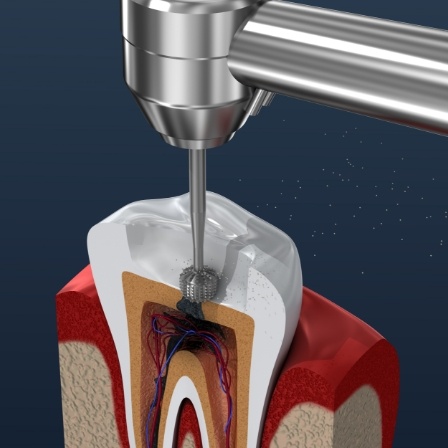 Illustrated dental instrument treating the inside of a tooth