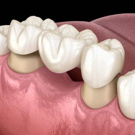 Illustrated dental bridge replacing a missing tooth