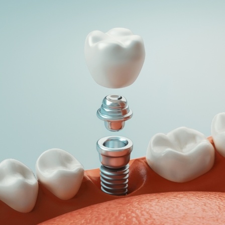 Illustrated dental implant replacing a missing tooth