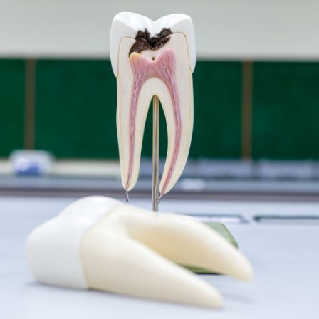 Model of damaged tooth