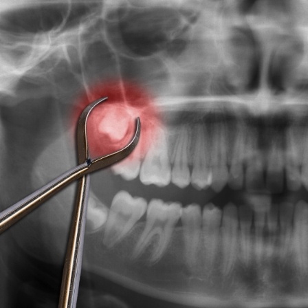 X ray of teeth with a wisdom tooth highlighted red