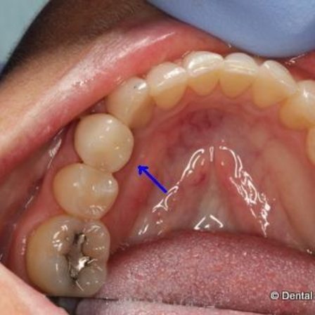 Close up of mouth with arrow pointing to natural looking dental crown