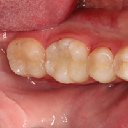 Close up of tooth with tooth colored filling