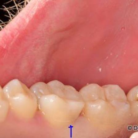 Arrow pointing to tooth with a filling