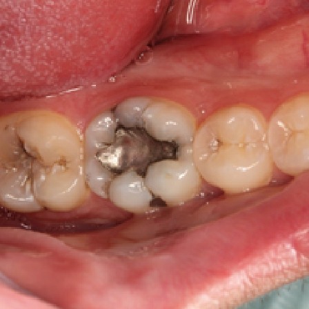 Close up of tooth with metal filling
