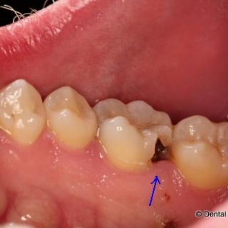 Arrow pointing to tooth with large cavity