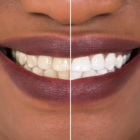 Closeup of patient's smile before and after teeth whitening treatment