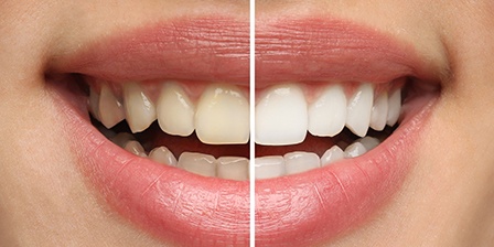 Closeup of a smile that’s split in half to show impact of whitening treatment
