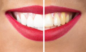 Ashamed of a stained smile? Brighten it with in-office or at-home teeth whitening from your cosmetic dentists in Oklahoma City, Drs. Colin and Jon Holman.