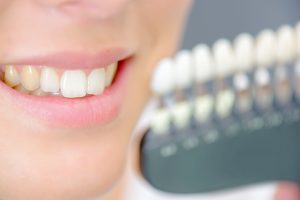 woman smiling with discolored teeth