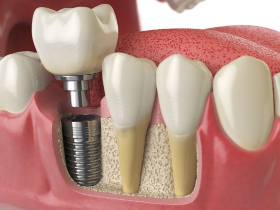 side view of dental implant