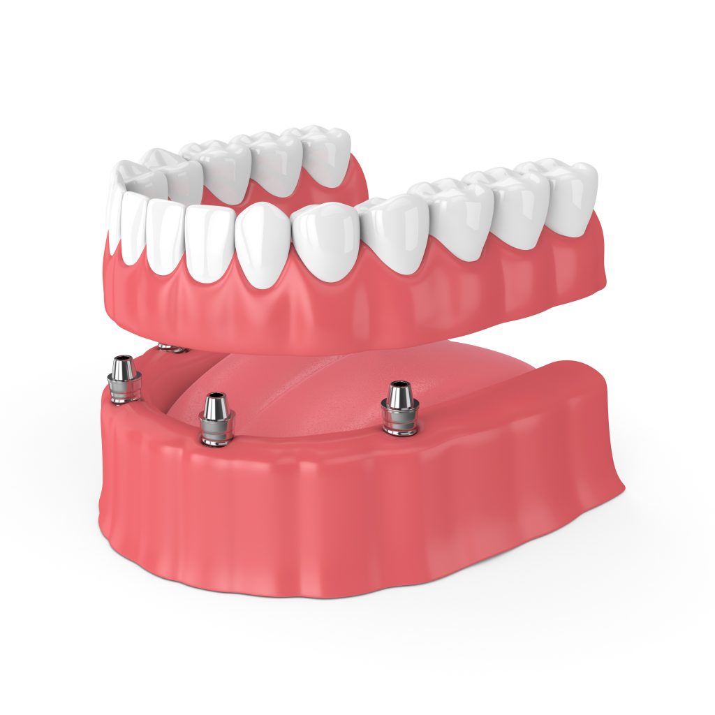 Model of an implant-retained denture