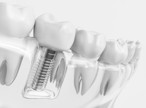 Dental implant alongside teeth